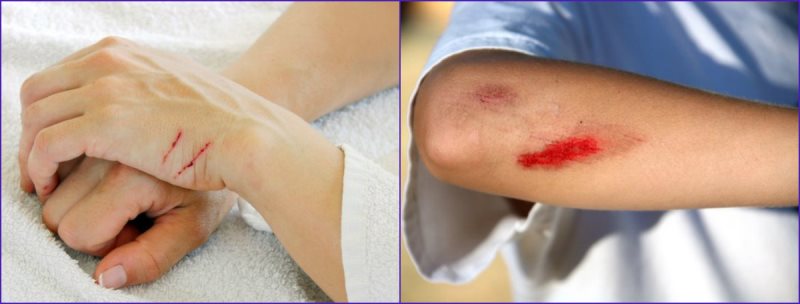 ob-opasnosti-melkix-travm