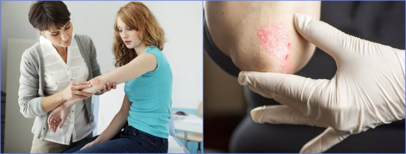 pochemu-voznikaet-psoriaz