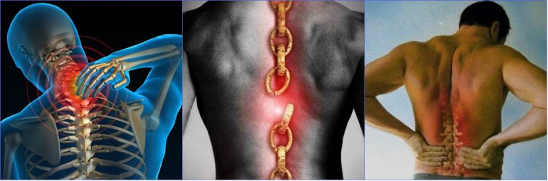 osteoxondroz-priznaki-prichiny